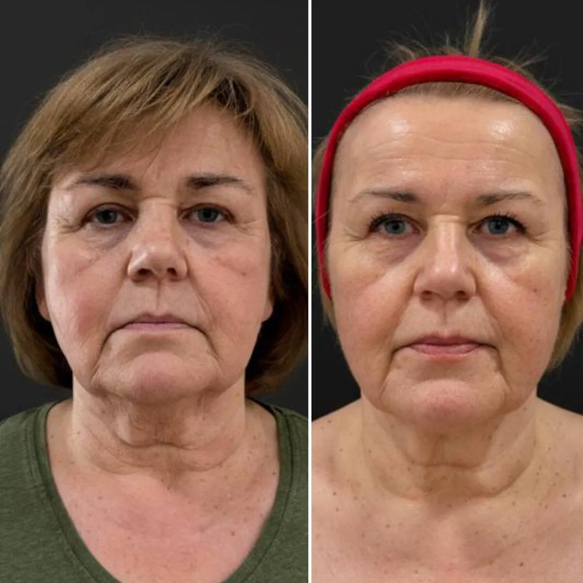 Efekty termoliftingu falą radiową monopolarną