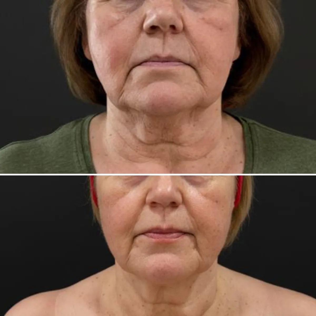 Efekty termoliftingu falą radiową monopolarną