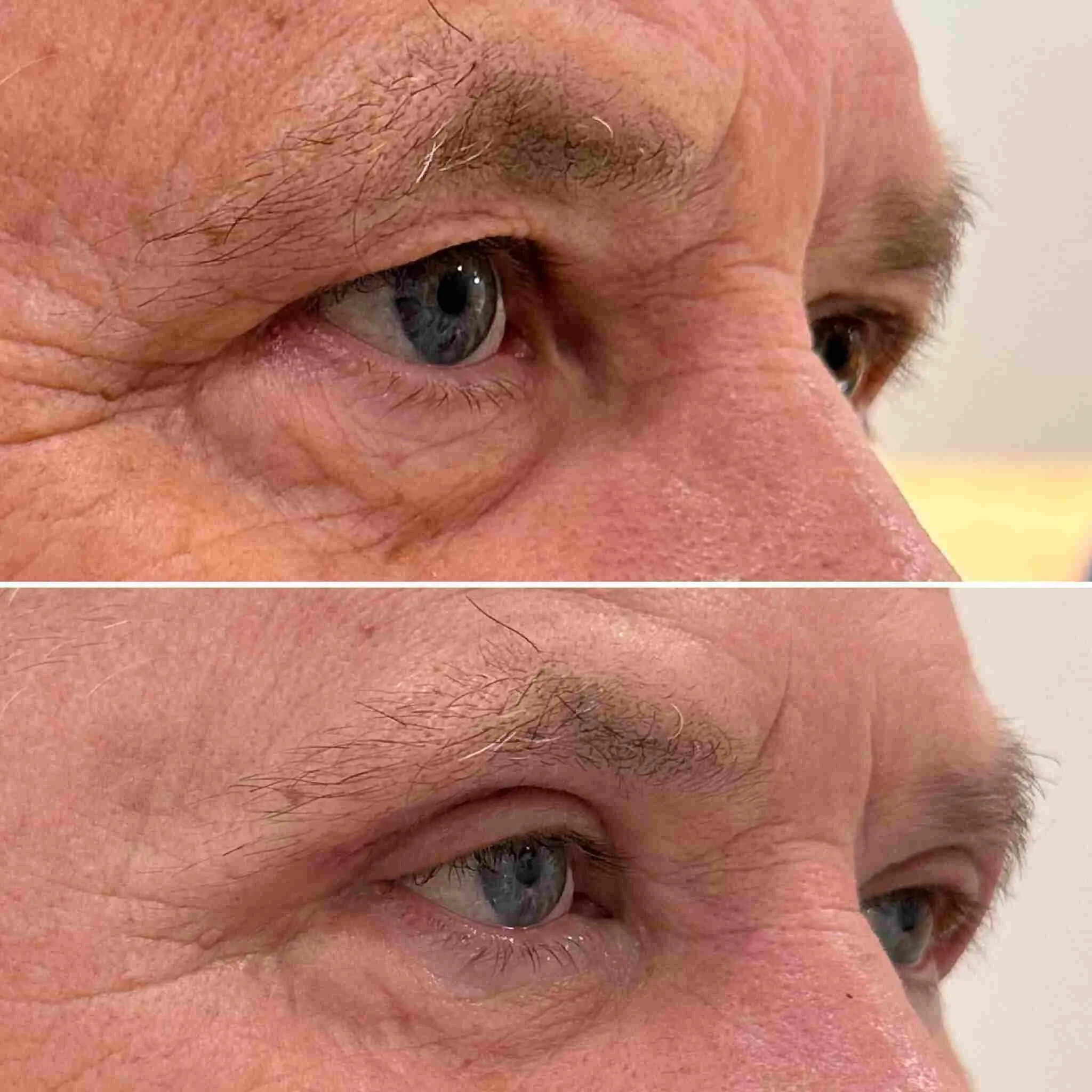 męska plastyka powiek (1)