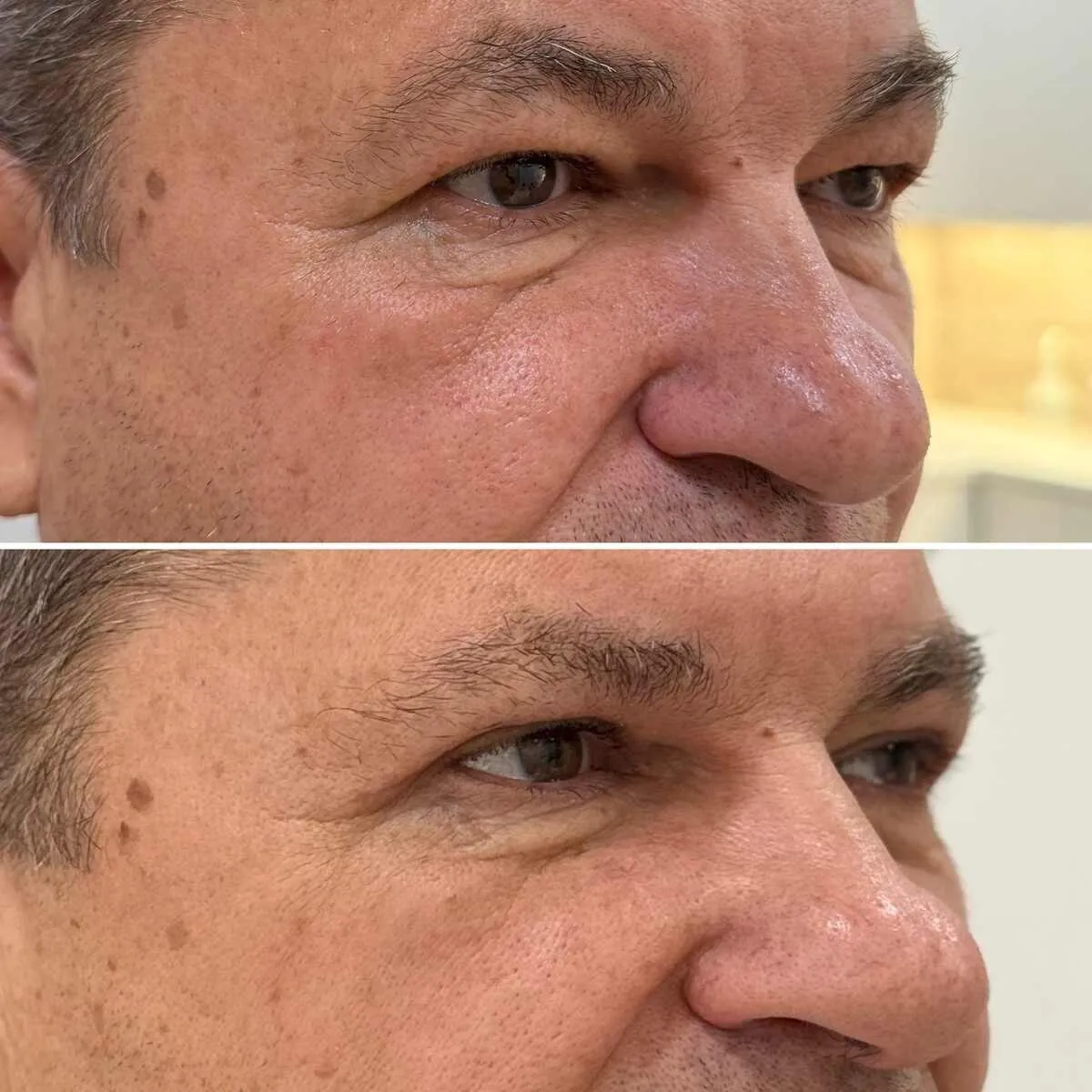 męska plastyka powiek (2) (1)