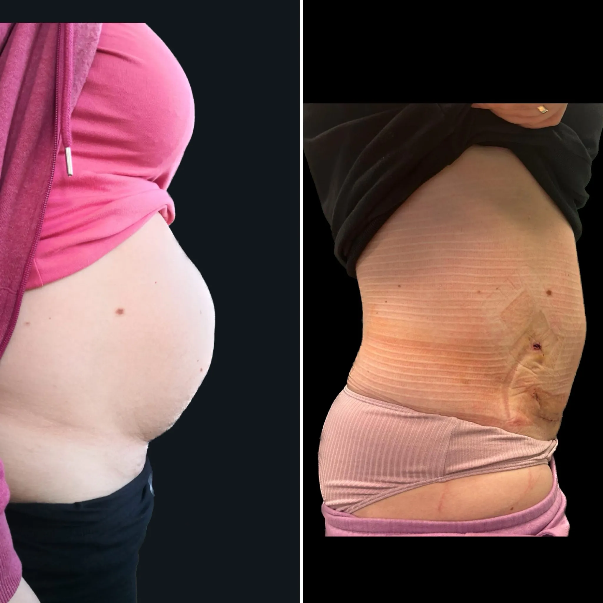 abdominioplastyka-gdansk