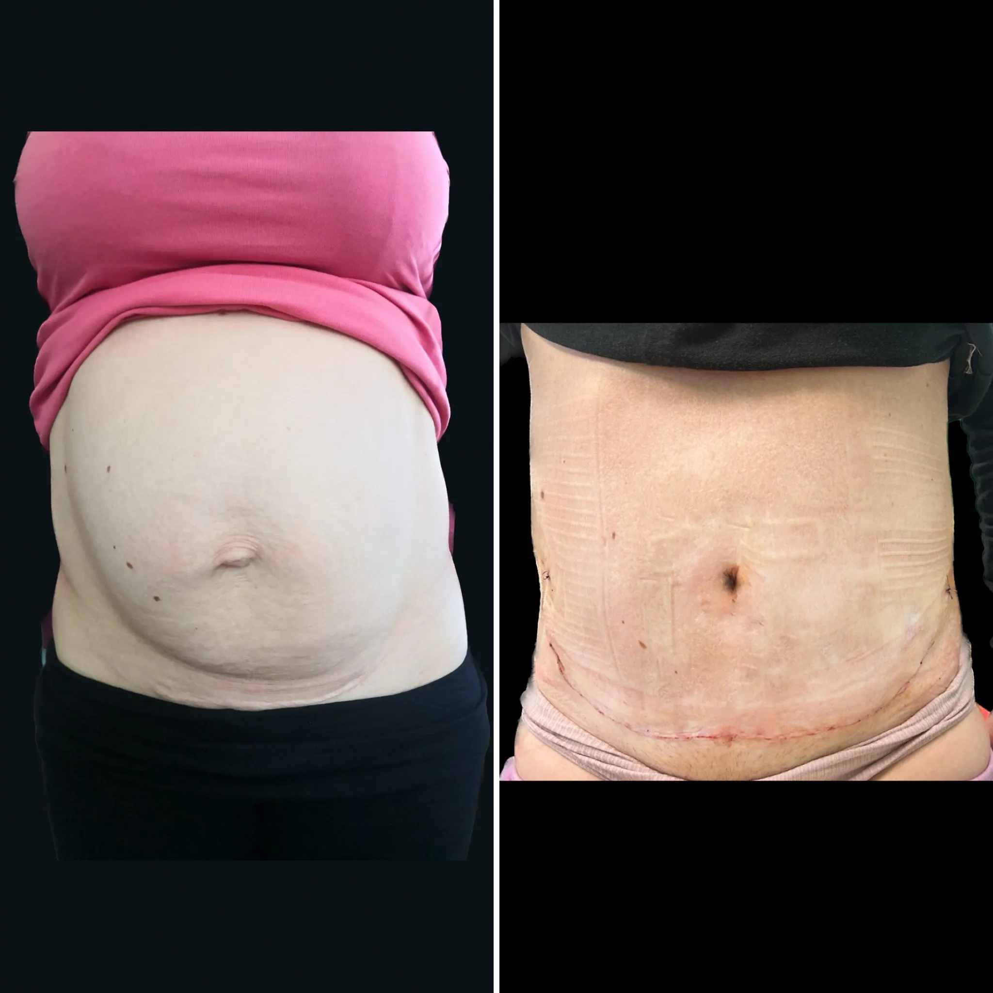 poporodowa niewydolnosc przedniej sciany brzucha przed i po - abdominoplastyka gdansk