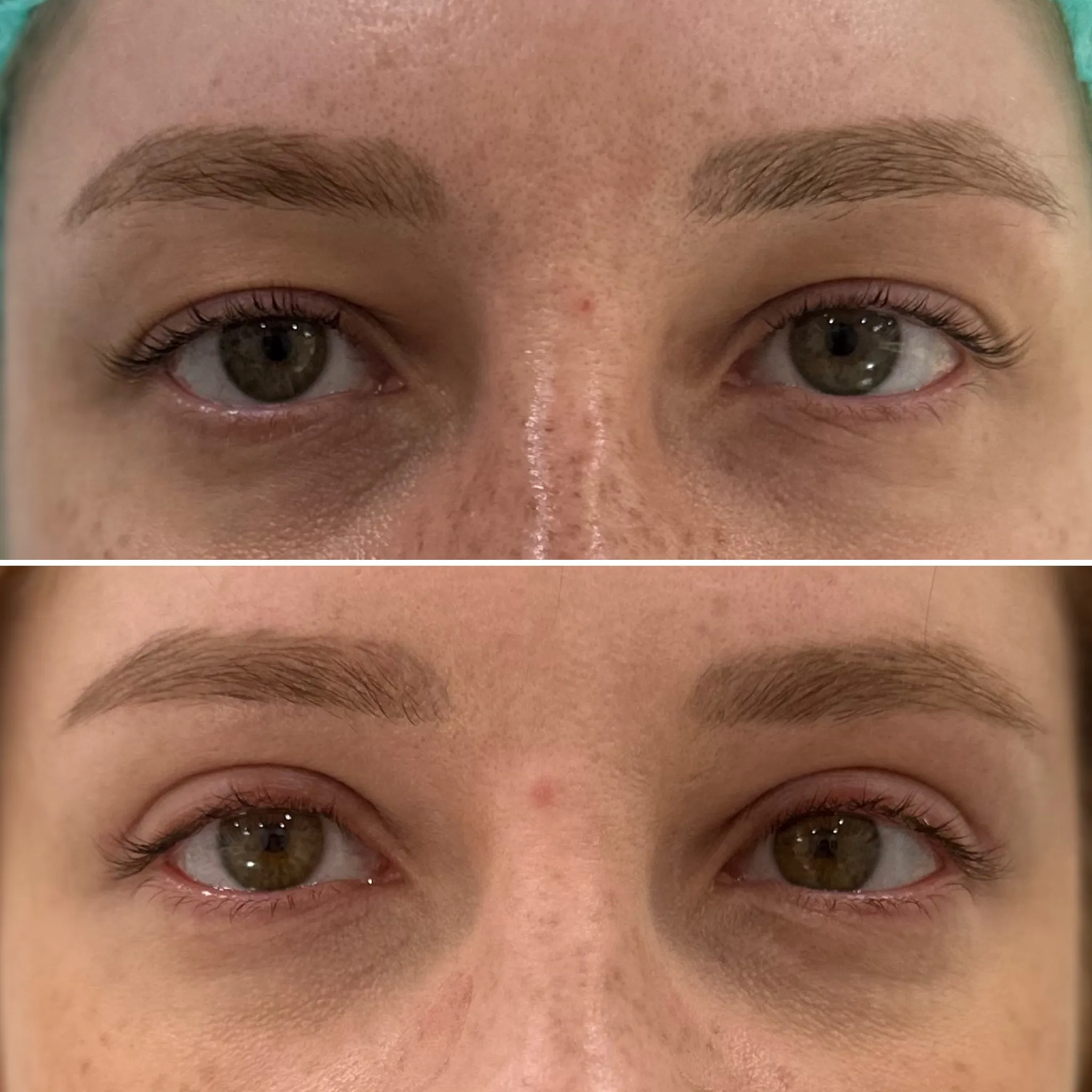 blefaroplastyka gdańsk
