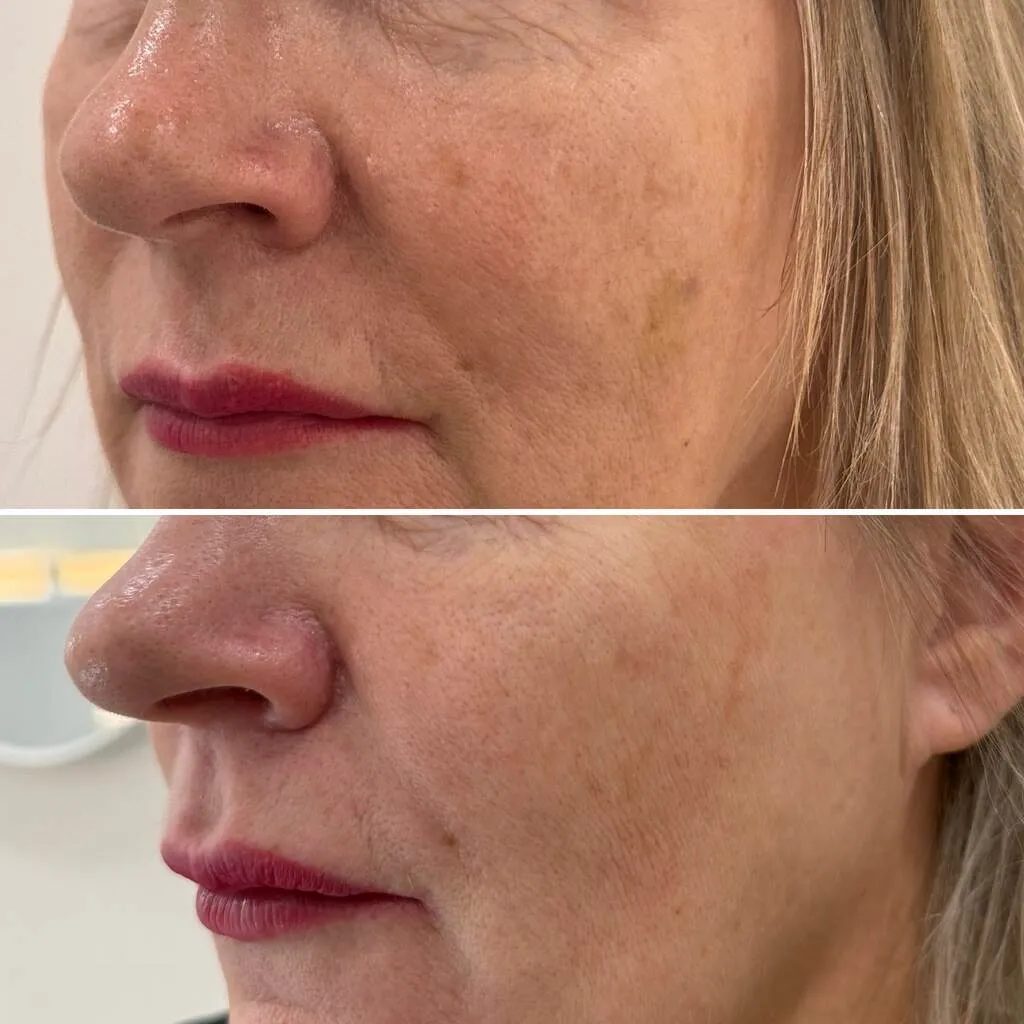 laser tulowy (2) (1)