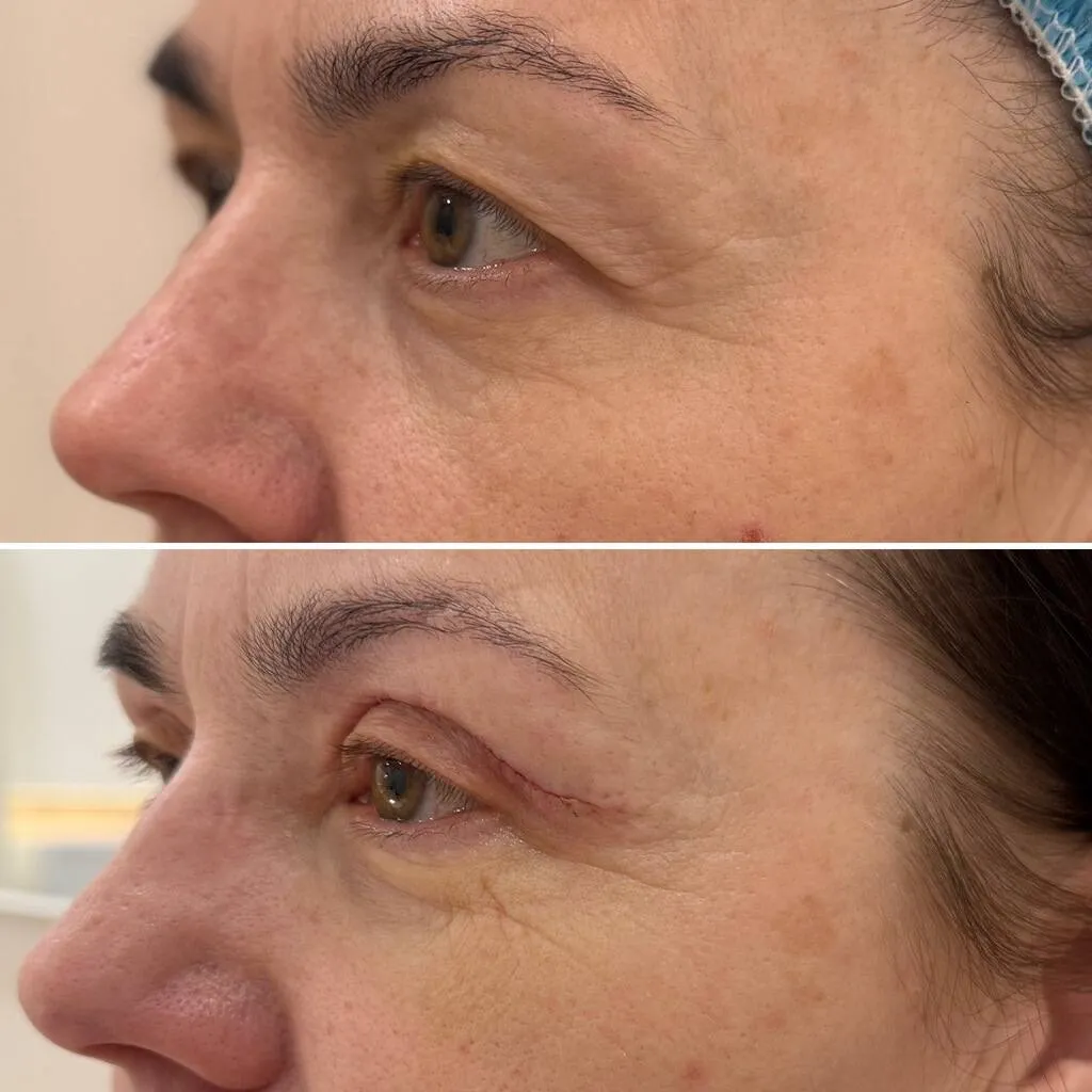 blefaroplastyka gdańsk (2) (1)