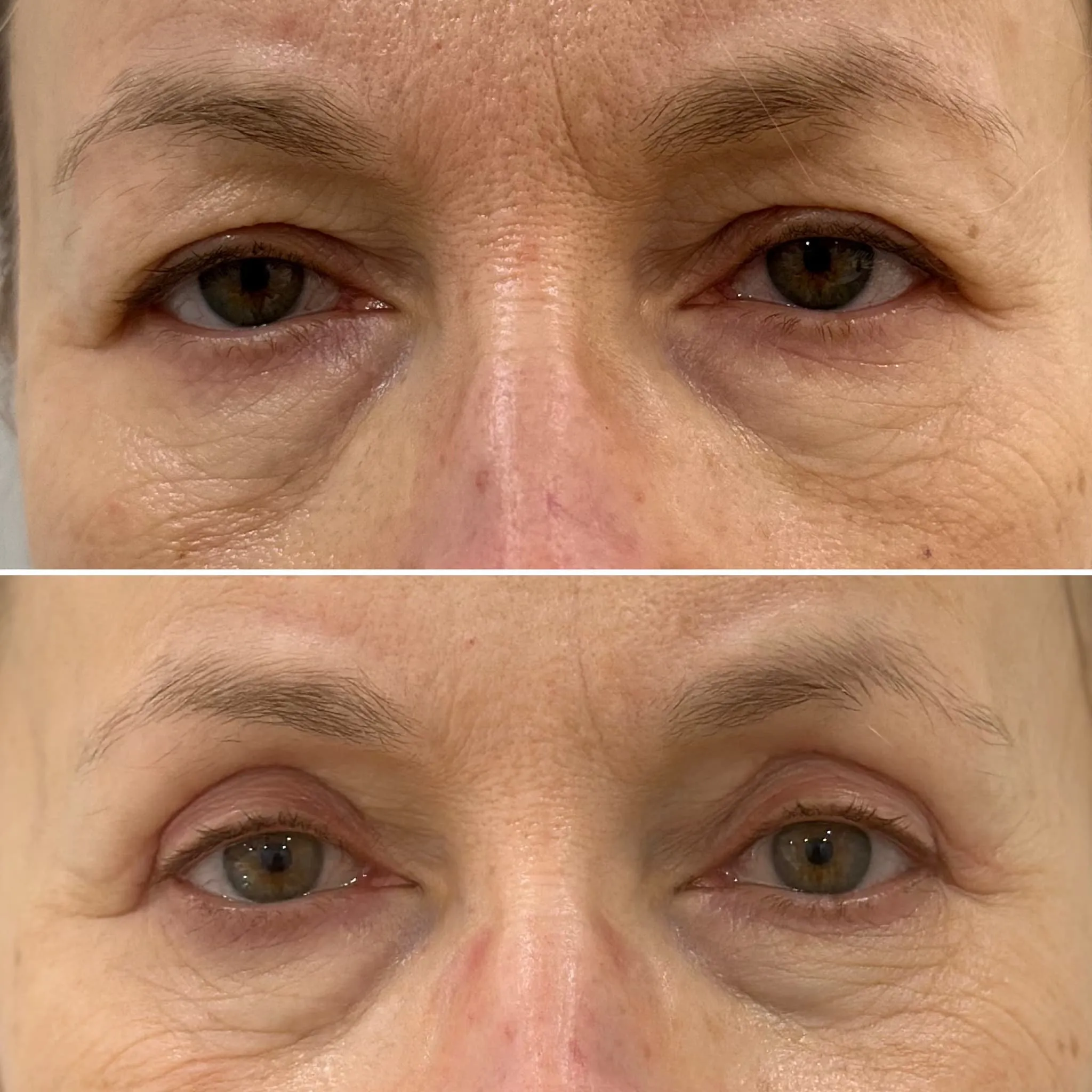 blefaroplastyka-zabieg-gdansk-trojmiasto-gunarys