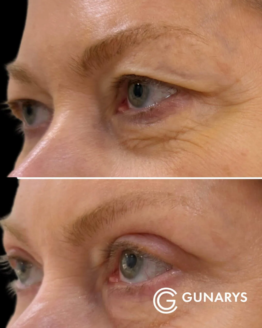 plastyka powiek (3) (1)