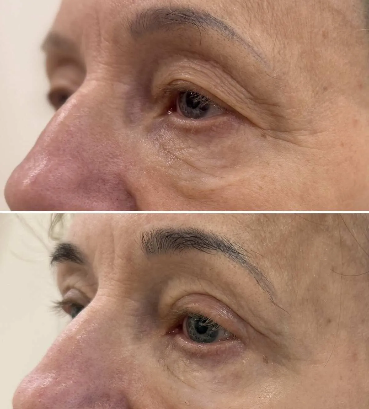 plastyka powiek górnych