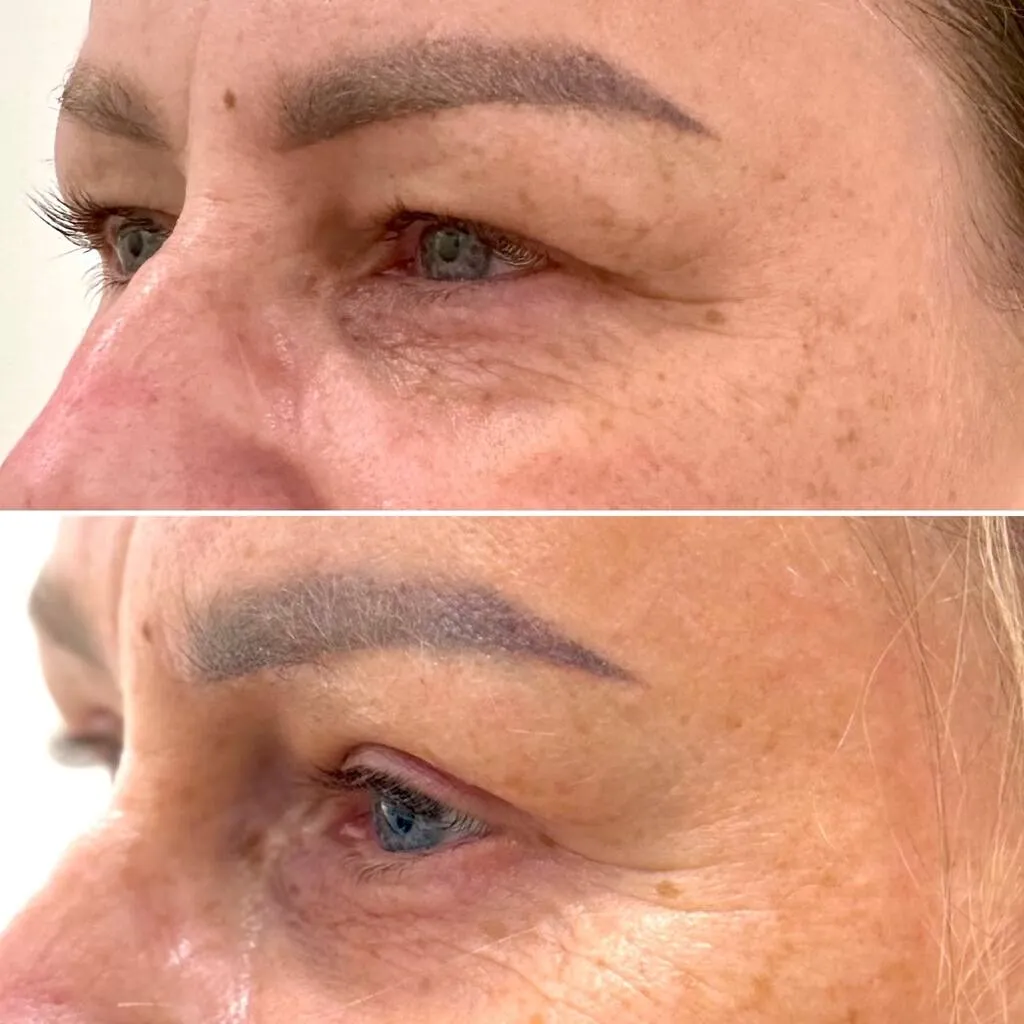 Plastyka powiek przed i po (1)