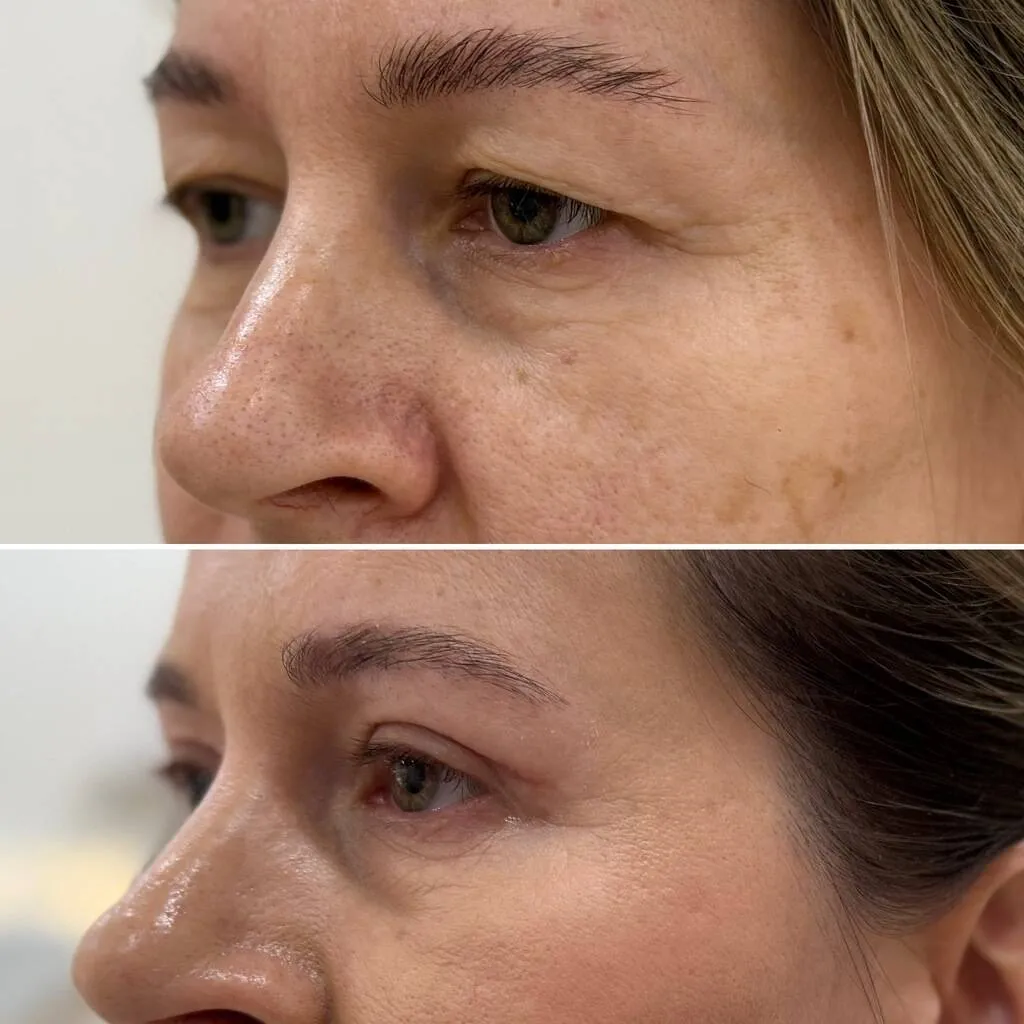 Plastyka powiek przed i po (2) (1)