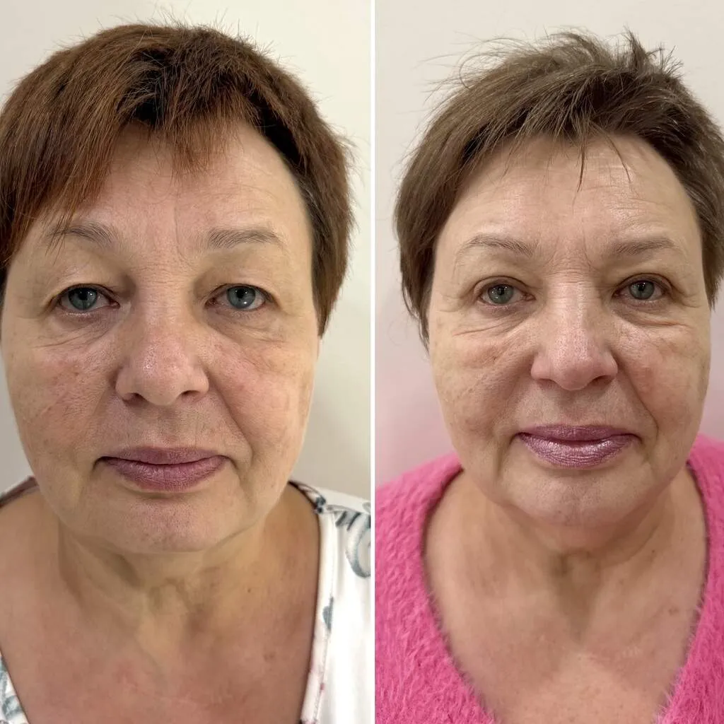 Plastyka powiek przed i po (3) (1)