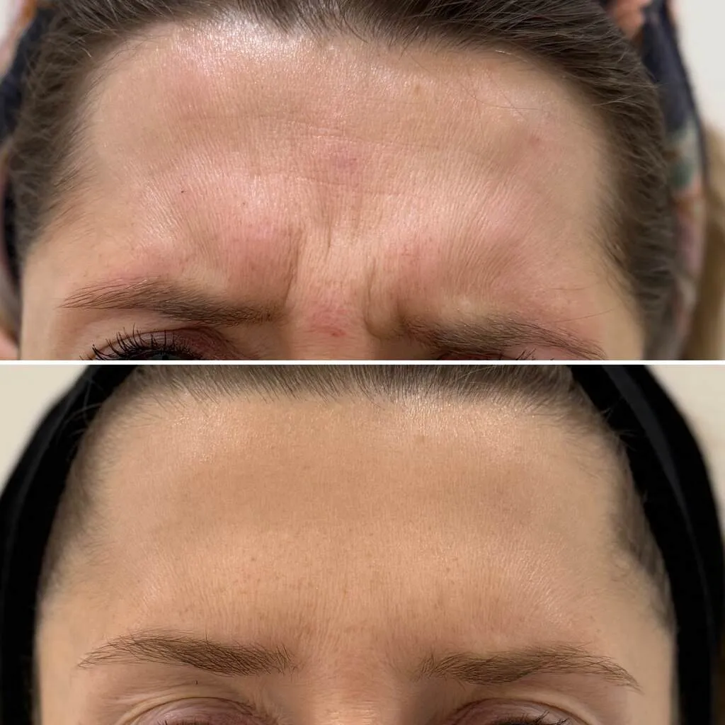 toksyna botulinowa lwia zmarszcz (1)