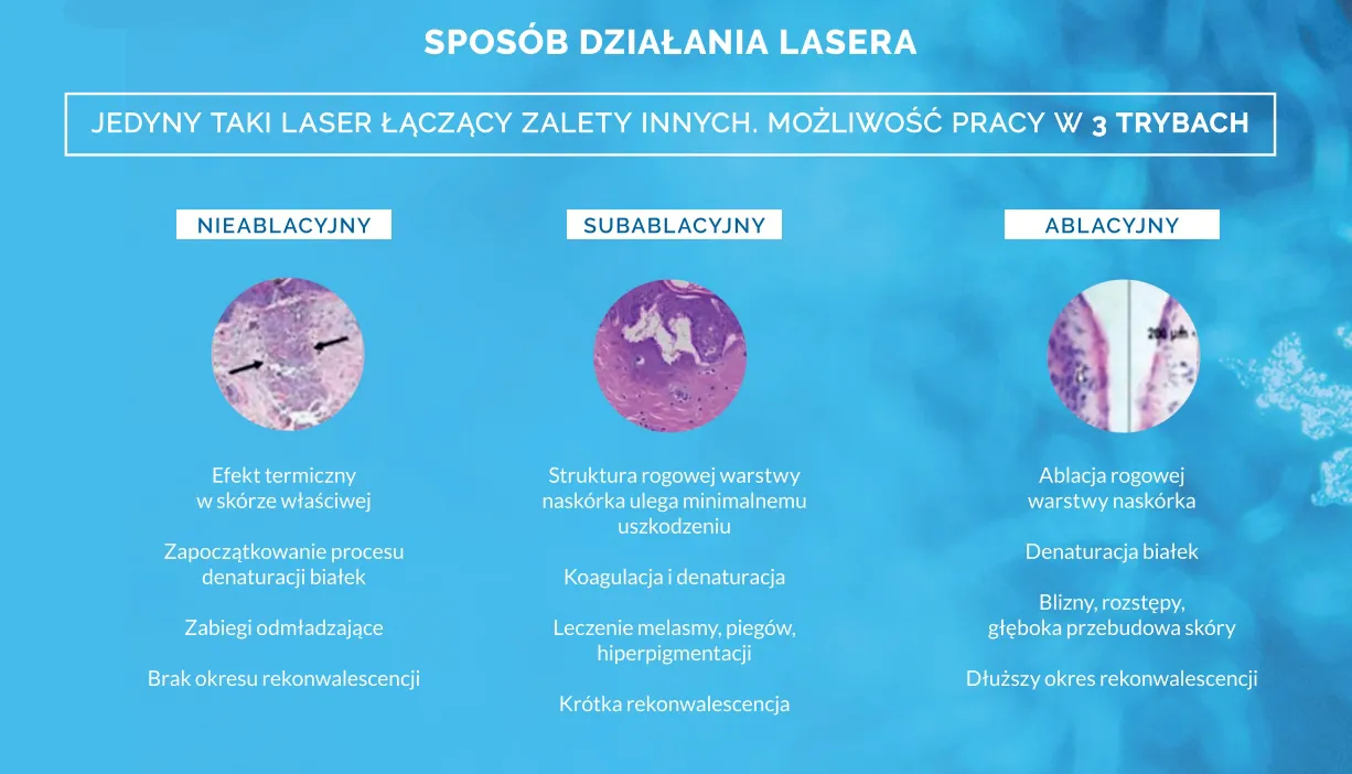 jak-działa-laser-tulowy-leczenie-przebarwien-gdansk
