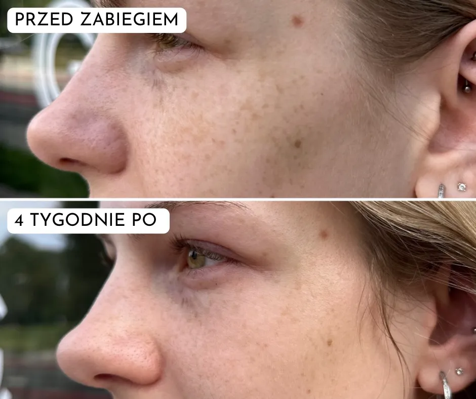 laser-tulowy-lavieen-przebarwienia