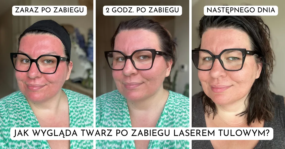 jak-wyglada-twarz-po-laserze-lavieen