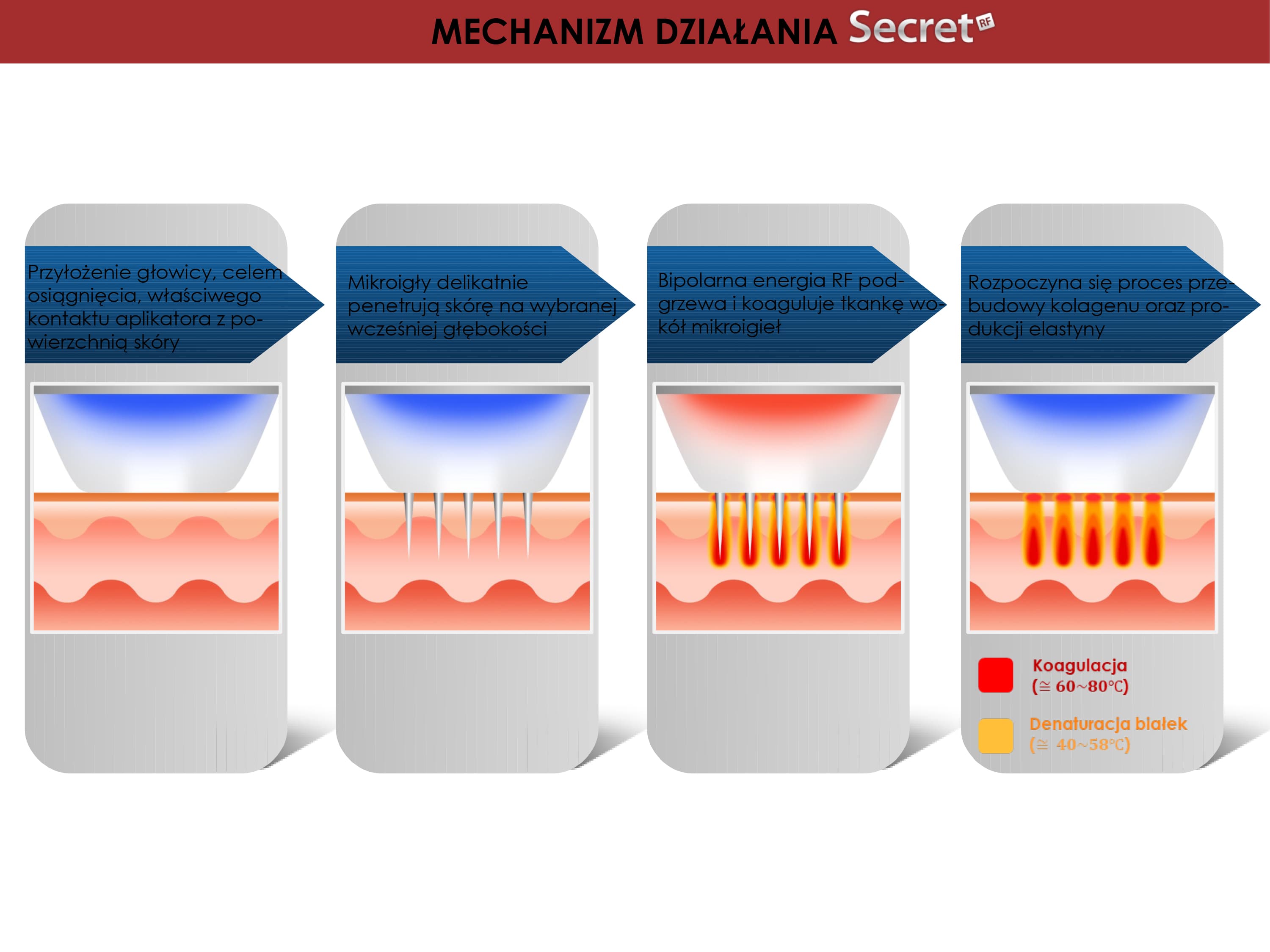 jak działa radiofrekfencja mikorigłowa secret RF