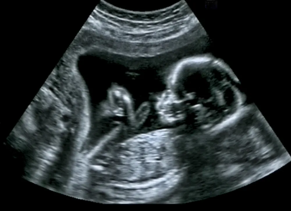 badania prenatalne 2 trymestr